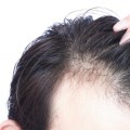 Does a lack of vitamin d cause hair loss?