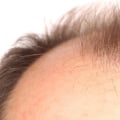 How much b12 should i take for hair growth?